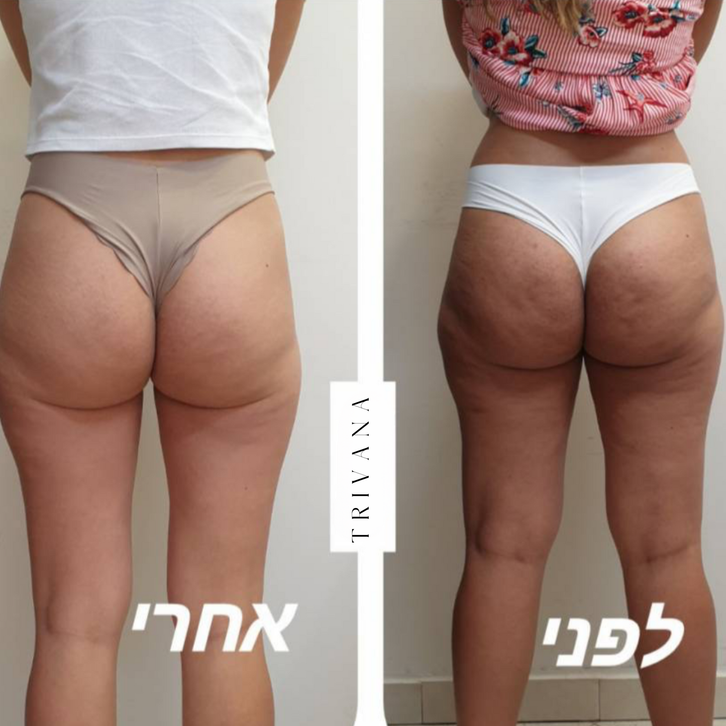 מכשיר עיסוי נגד צלוליט